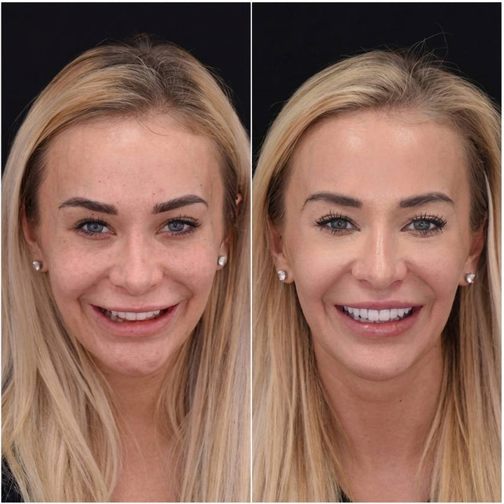 Snap On Veneers, Natural Looking Veneers for Upper and Lower Teeth, Instant Smile Makeover