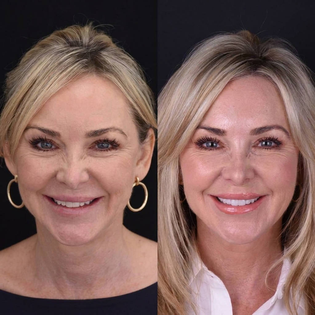Snap On Veneers, Natural Looking Veneers for Upper and Lower Teeth, Instant Smile Makeover