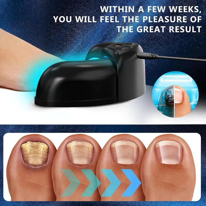 Nail Fungus Laser