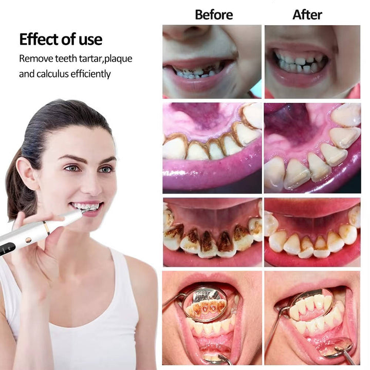 Electric Dental Teeth Calculus and Tartar Remover Kit, 5 Adjustable Modes with Led Light