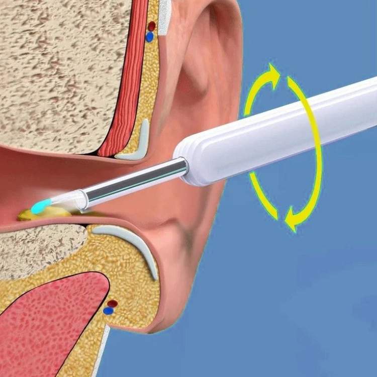 Ear Wax Removal Camera with LED Illumination and Rechargeable Handle, Wireless Viewing