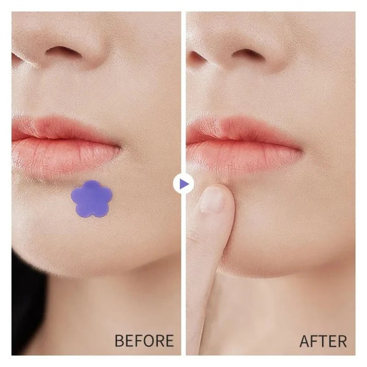 Acne Patch Stickers with Hydrocolloid Material